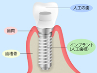 インプラント