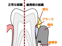 健康でいるために歯周病予防を