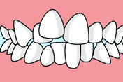上顎前突（出っ歯）